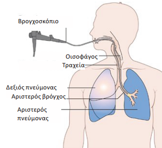 Βρογχοσκόπηση